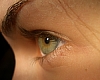 Genital Herpes Increases Among Young American Women
